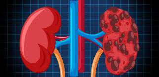 Chronic Kidney Disease